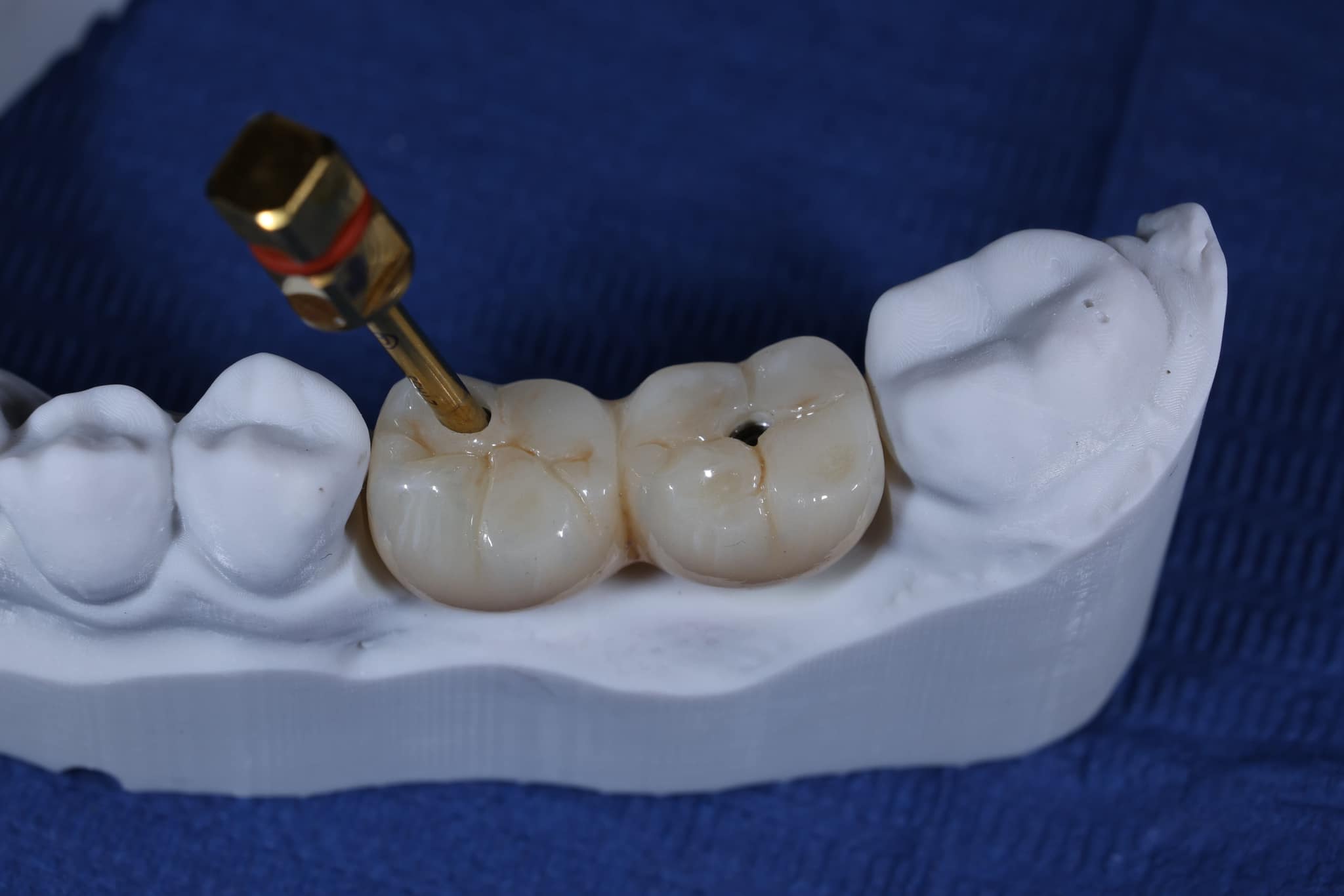 Implants