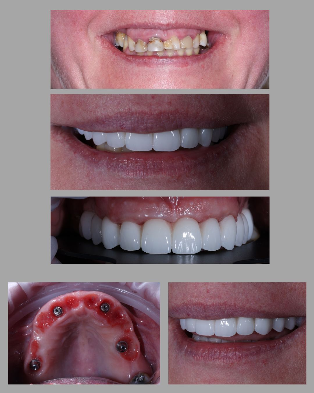 Blue and White Bold Minimalistic Tooth Whitening Before After Instagram Post